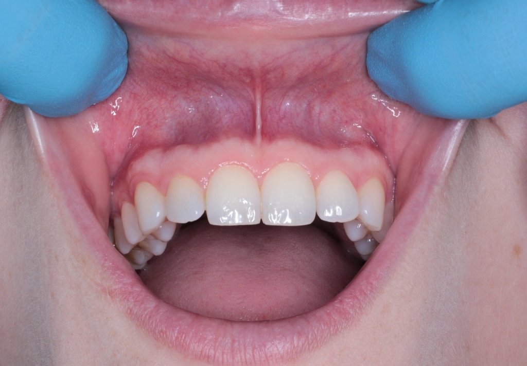 Dentální hygiena s anestezií