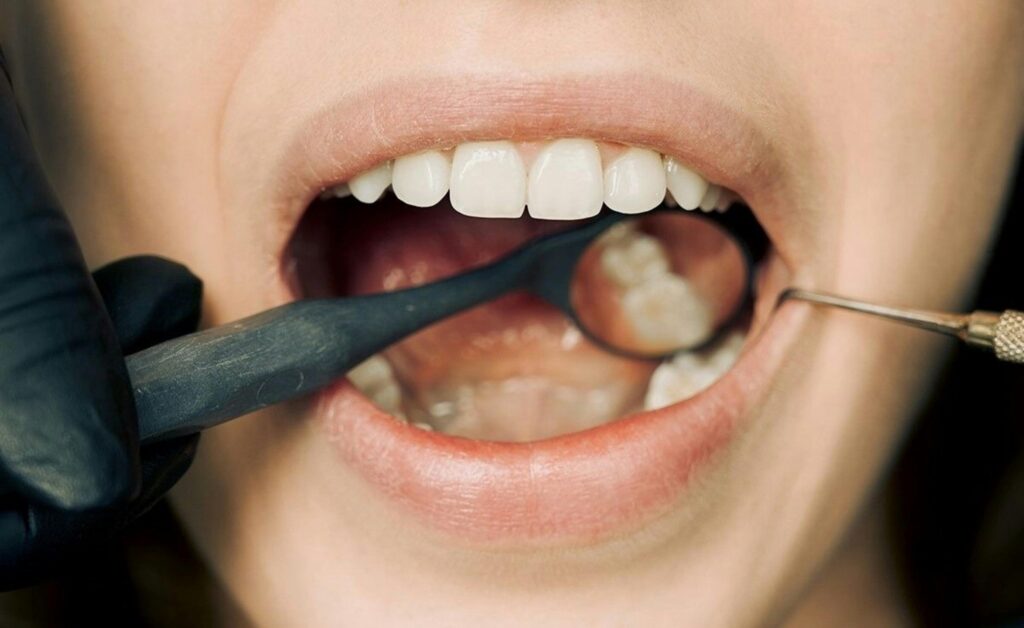 Příspěvky na dentální hygienu 2025 – kompletní přehled pojišťoven